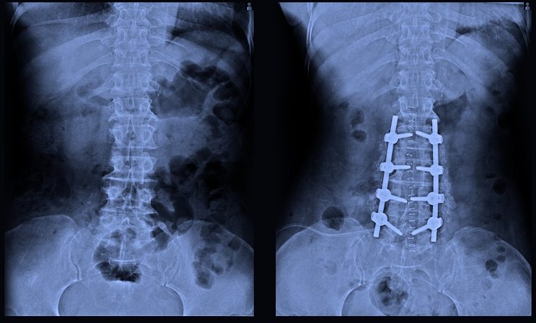 spinal fusion surgery