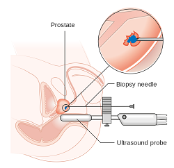 prostate biopsy