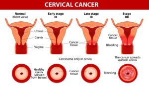 CERVICAL CANCER TREATMENT COST IN INDIA