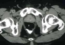 ct scan prostate