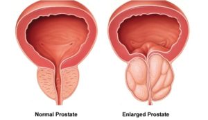 prostate enlargement- lyfboat