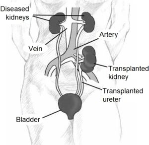 new kidney transplant