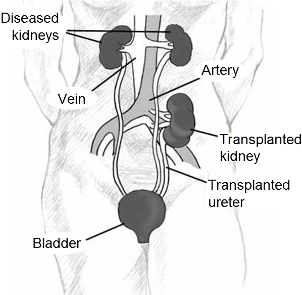 kidney transplant waiting