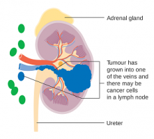 kidney cancer treatment