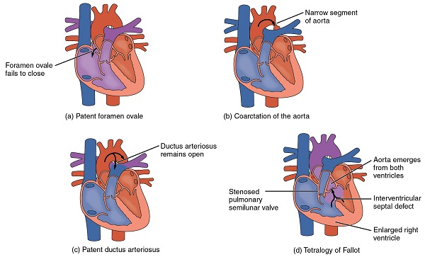 congenital heart defect