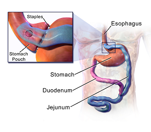 gastric-bypass-surgery-process