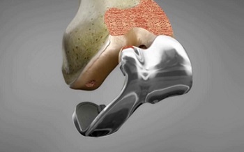 knee implants in india