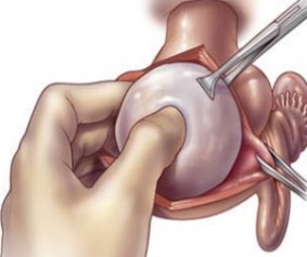 fibroid removal