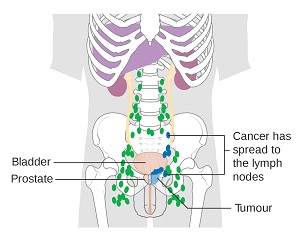 prostate cancer stage 4 treatment in india)
