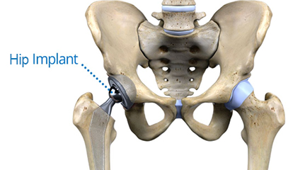 Hip Replacement Cost in India