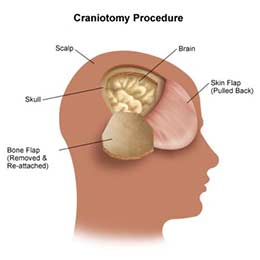 Craniotomy Infographics
