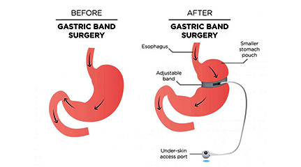 Gastric Band Surgery Cost in India