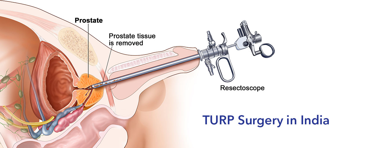 TURP Surgery in India