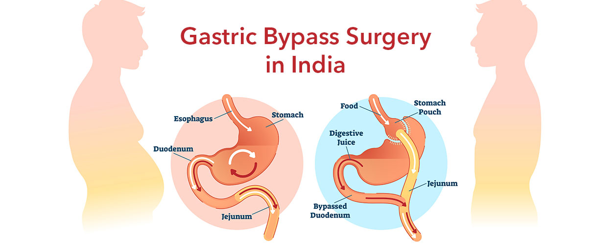 Gastric Bypass Abroad