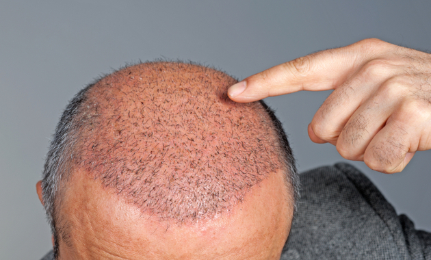 How Much Does 5000 Grafts Hair Transplant Cost?