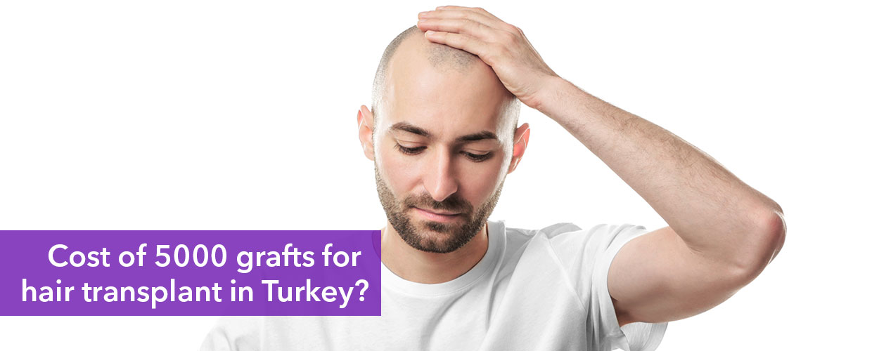 5000 Grafts Hair Transplant Cost in Turkey
