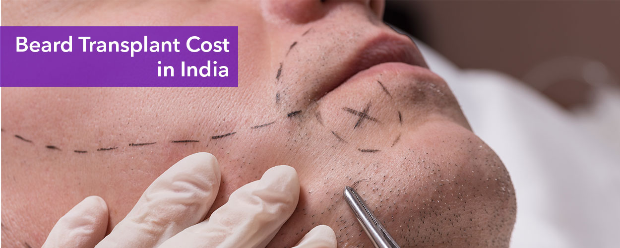 Beard-transplant-cost-in-India