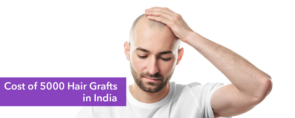 5000 Grafts Hair Transplant Cost in India