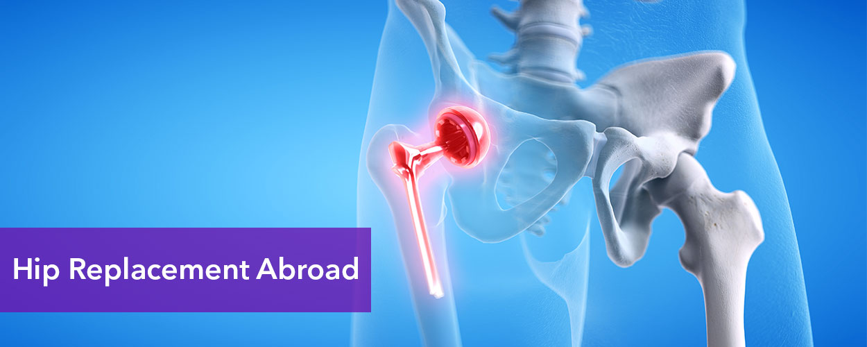 Hip Replacement Abroad