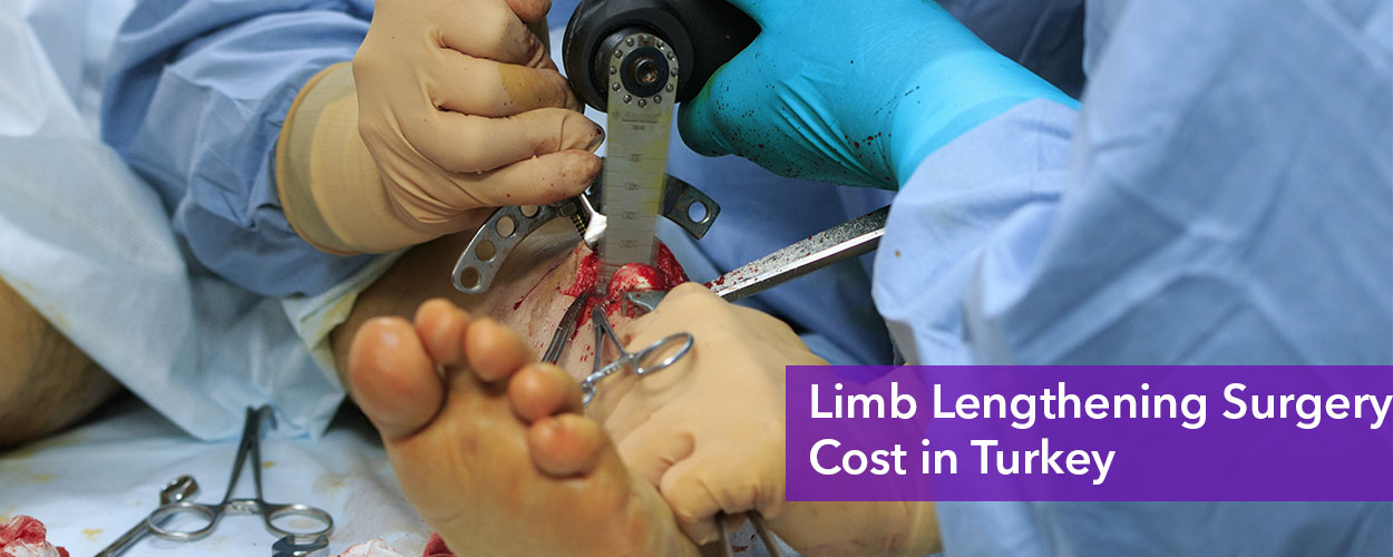 Limb Lengthening Surgery Cost in Turkey
