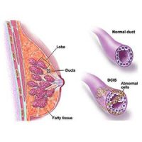 Ductal-Carcinoma-in-Situ-Breast-Cancer