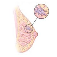Invasive-Lobular-Carcinoma-Breast-Cancer